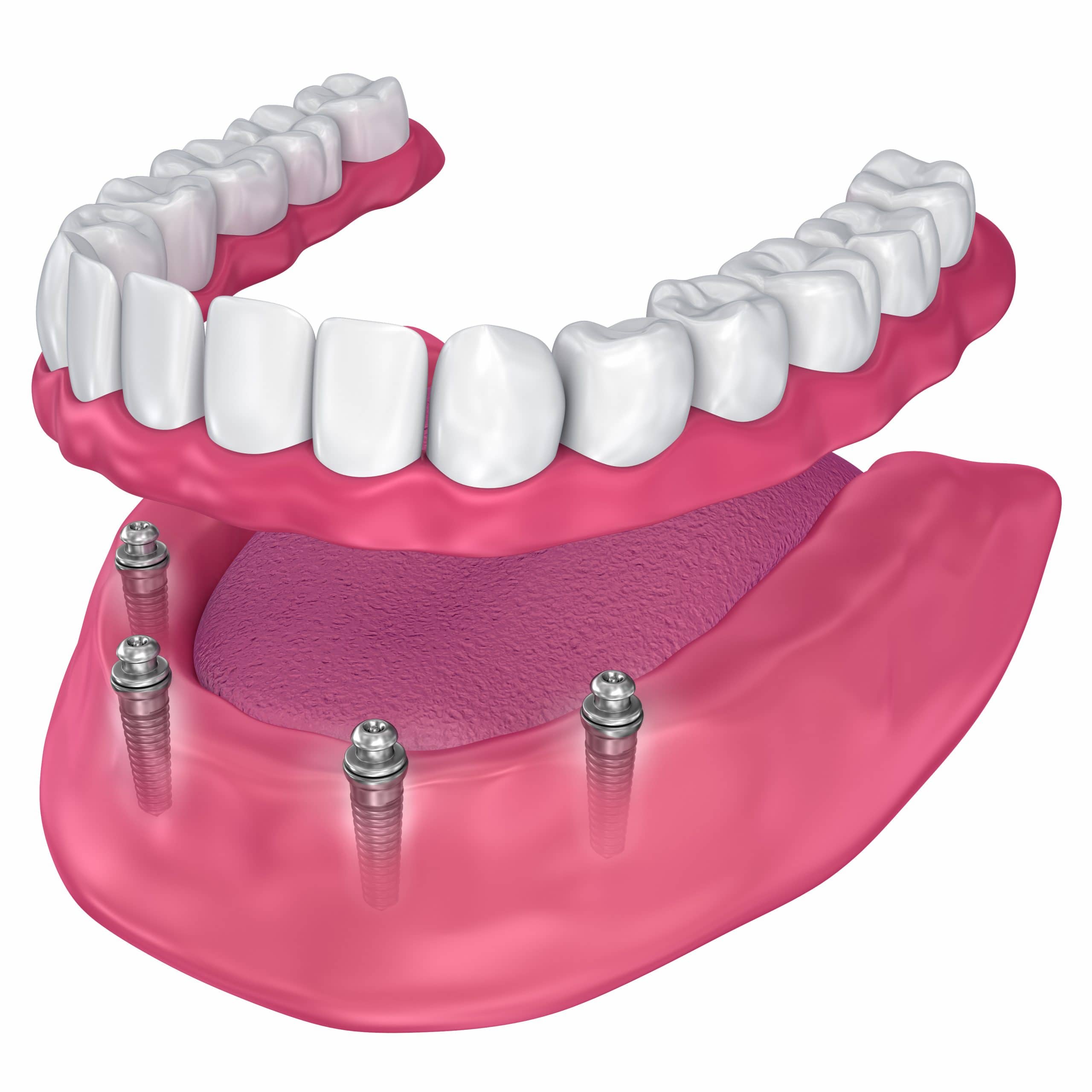 Dental Implants in Saginaw TX - Blue Sky Smiles